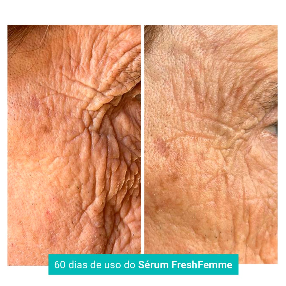 Kit Spray Refrescante Para Calores Menopausa FreshFemme + Sérum Concentrado Preenchedor de Rugas e Linhas de Expressão FreshFemme