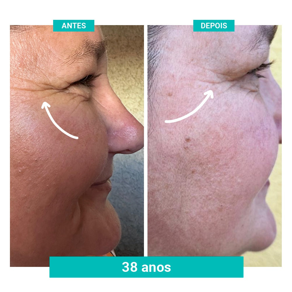 Kit Spray Refrescante Para Calores Menopausa FreshFemme + Sérum Concentrado Preenchedor de Rugas e Linhas de Expressão FreshFemme