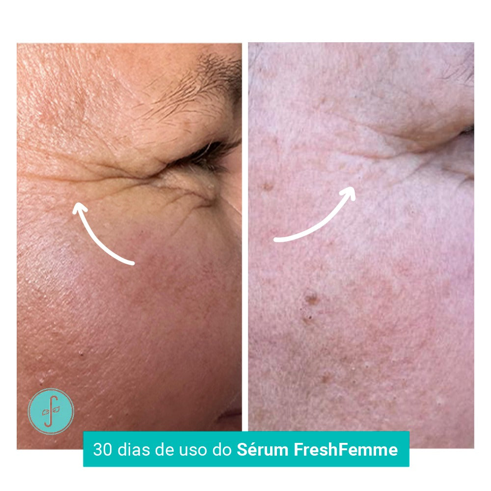 Sérum Concentrado Preenchedor de Rugas e Linhas de Expressão FreshFemme