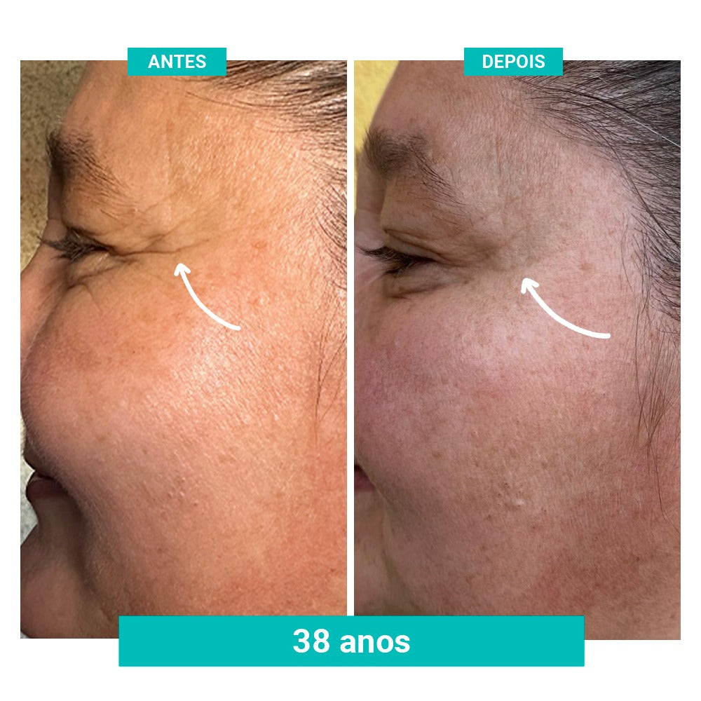 Sérum Concentrado Preenchedor de Rugas e Linhas de Expressão FreshFemme