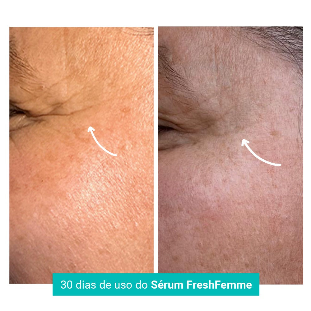 Kit Spray Refrescante Para Calores Menopausa FreshFemme + Sérum Concentrado Preenchedor de Rugas e Linhas de Expressão FreshFemme