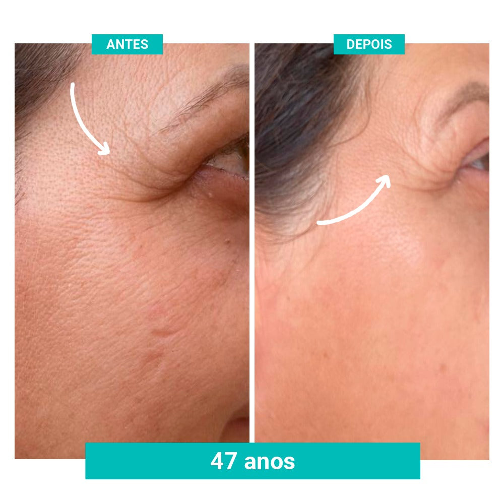 Kit Spray Refrescante Para Calores Menopausa FreshFemme + Sérum Concentrado Preenchedor de Rugas e Linhas de Expressão FreshFemme