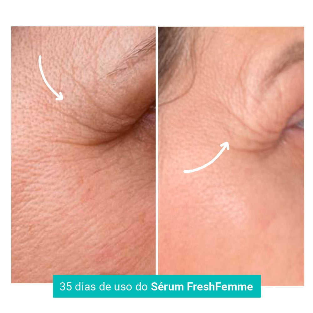 Kit Spray Refrescante Para Calores Menopausa FreshFemme + Sérum Concentrado Preenchedor de Rugas e Linhas de Expressão FreshFemme
