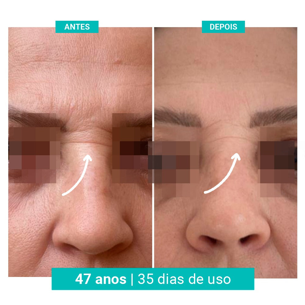 Kit Spray Refrescante Para Calores Menopausa FreshFemme + Sérum Concentrado Preenchedor de Rugas e Linhas de Expressão FreshFemme