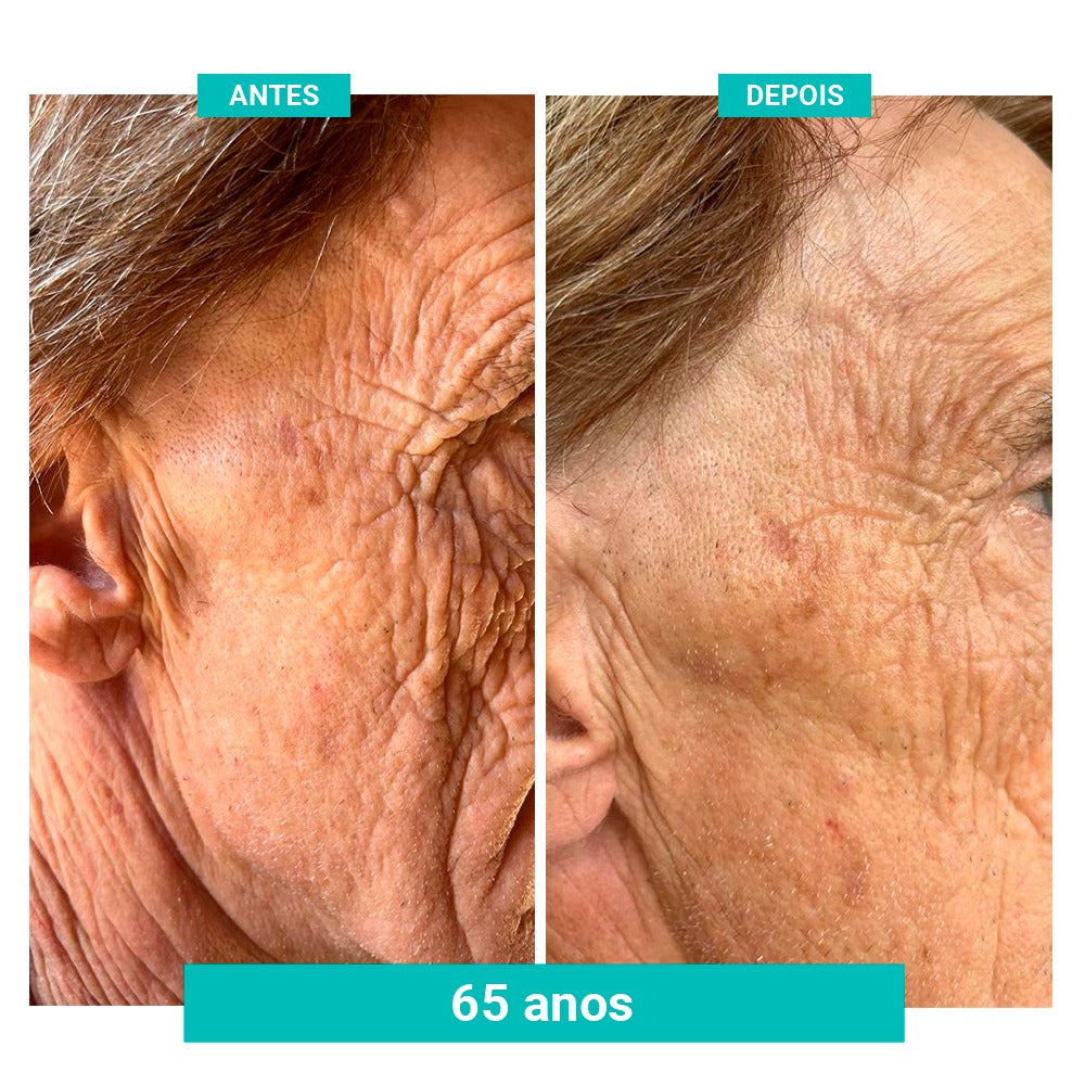 Kit Spray Refrescante Para Calores Menopausa FreshFemme + Sérum Concentrado Preenchedor de Rugas e Linhas de Expressão FreshFemme